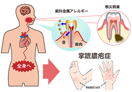 掌蹠膿疱症（しょうせきのうほうしょう）